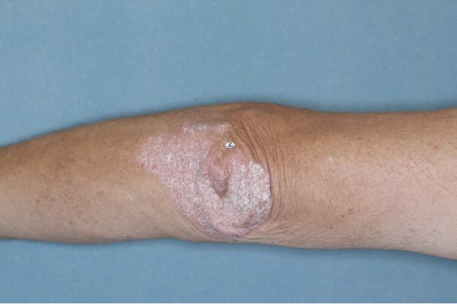 Before and after images of plaque psoriasis (scalp)