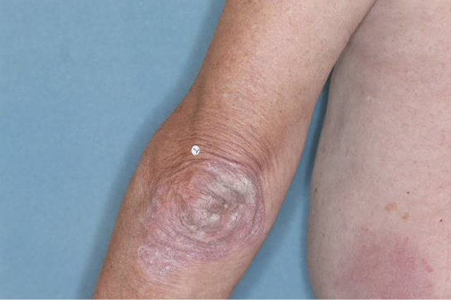 Before and after images of plaque psoriasis (scalp)