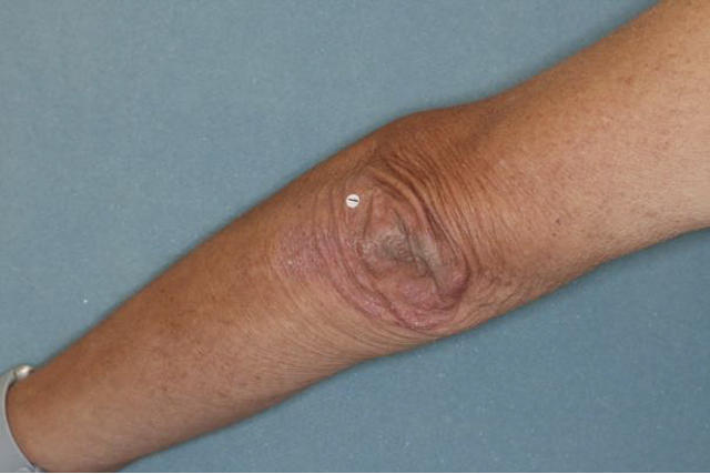 Before and after images of plaque psoriasis (scalp)